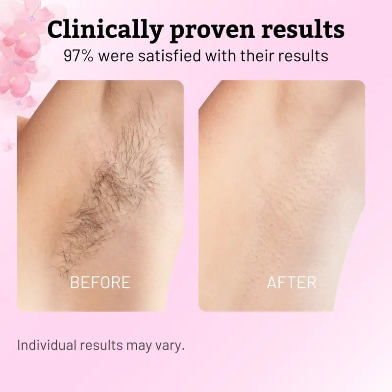 Cyperus Permanent Hair Removing Oil